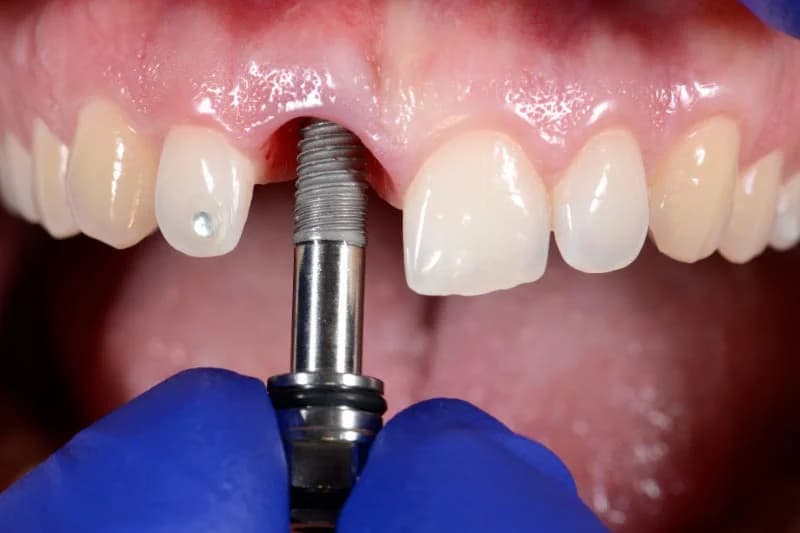 Implantes Dentales
