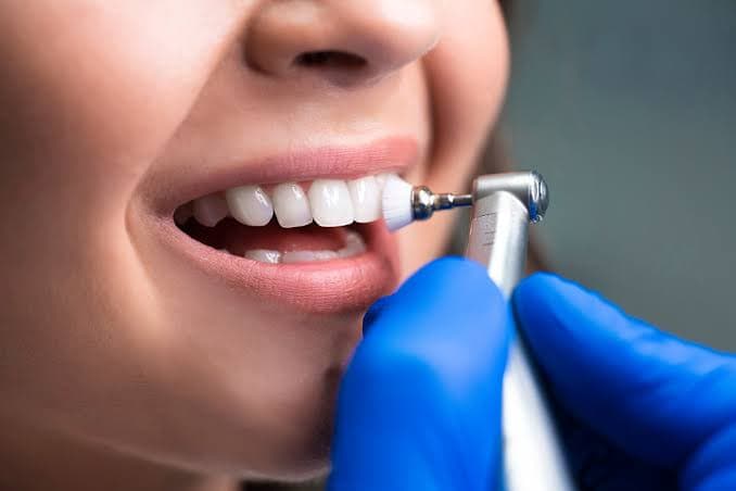 Limpieza Dental
